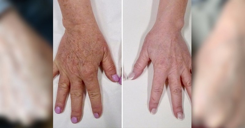 как вернуть коже упругость