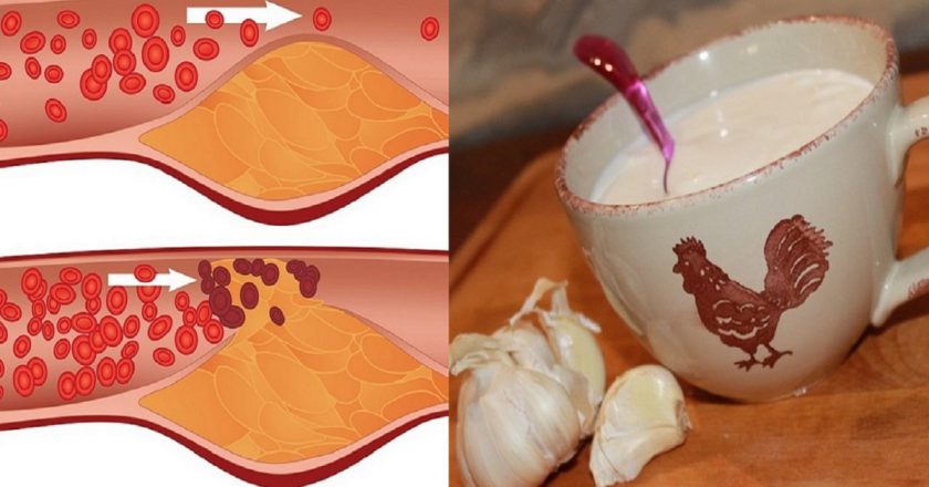 чистка сосудов чесноком