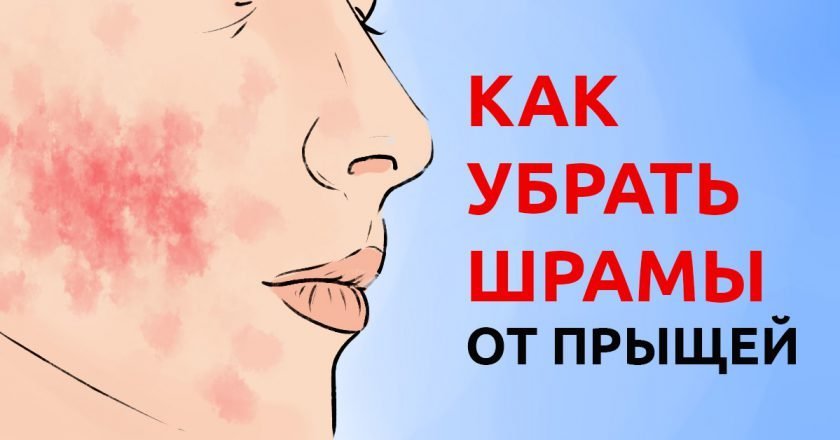 как избавиться от шрамов от прыщей