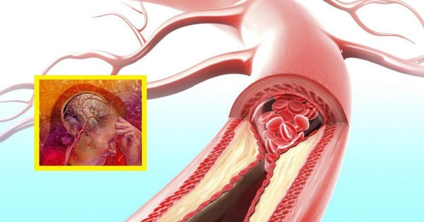 как укрепить сосуды