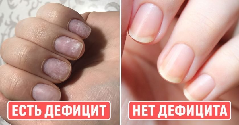 нехватка витамина С