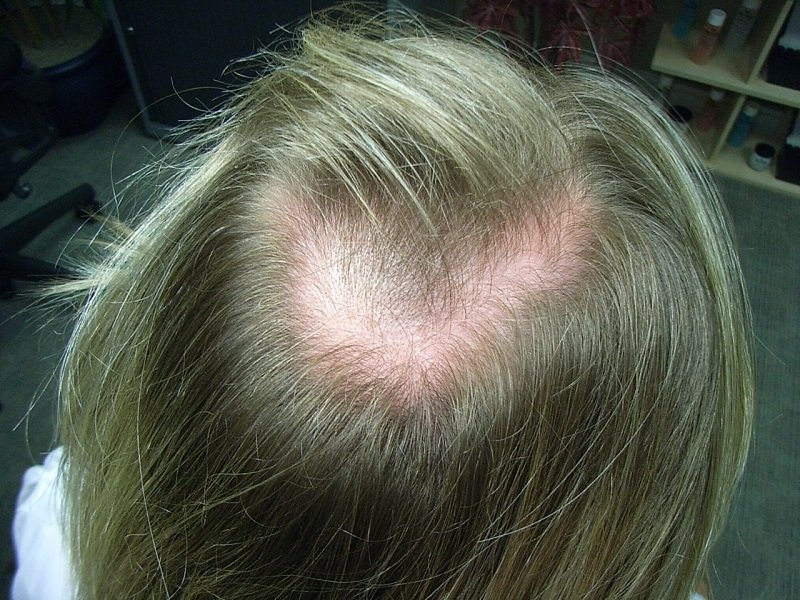 крапива от плешивости