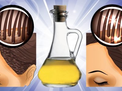 Уксус от перхоти