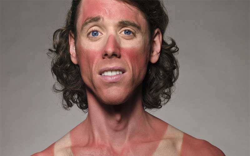 солнечные ожоги